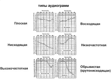 7 понятий аудиометрии-3